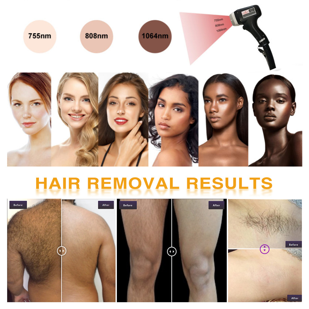 HAIR REMOVAL R ESULTS